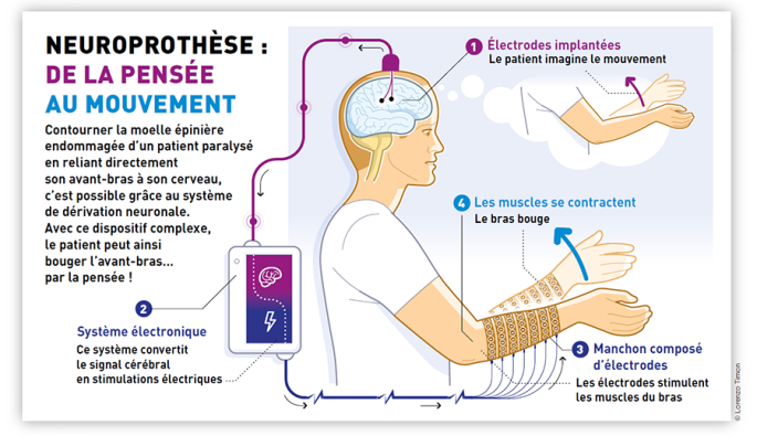 Neuroprothèse.png